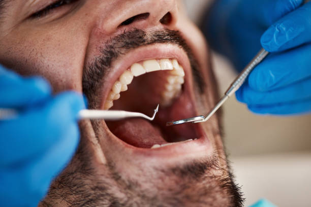 Best Emergency Tooth Extraction in Christiansburg, VA