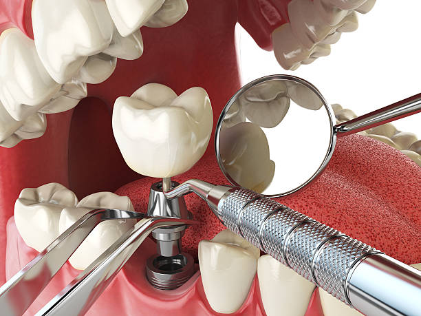 Best Emergency Wisdom Teeth Removal in Christiansburg, VA