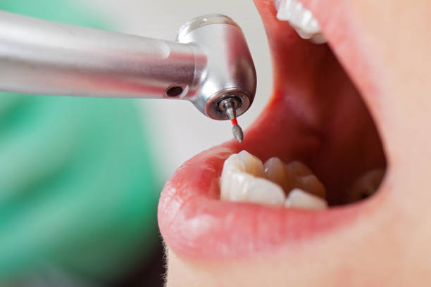 Best Emergency Tooth Extraction in Christiansburg, VA